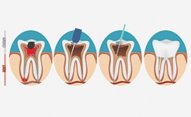 Root Canal Therapy